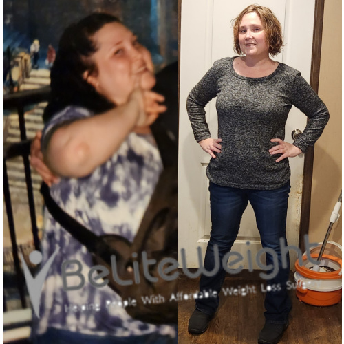 Weight Loss Surgery Gastric Sleeve before and after